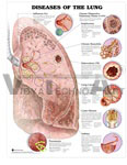 Diseases of the Lung Anatomical Chart